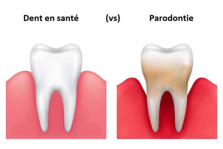 Parodontie - Centre dentaire STéphane Girard à St-Jérôme