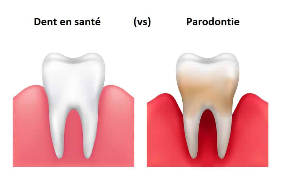 Parodontie – Centre dentaire STéphane Girard à St-Jérôme Parodontie - Centre dentaire STéphane Girard à St-Jérôme