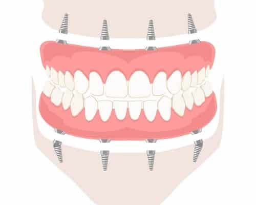 Implant dentaire - Centre dentaire Stephane Girard a St-Jerome (4)